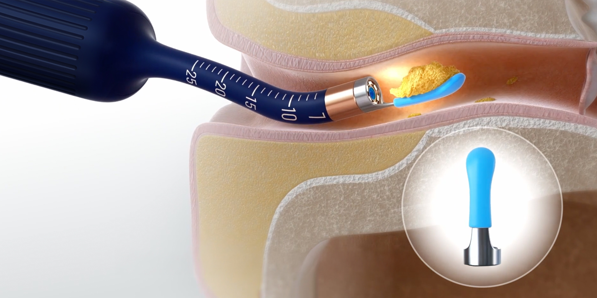 width=100% Urządzenie do czyszczenia uszu Bebird EarSight Plus I35R - niebieski